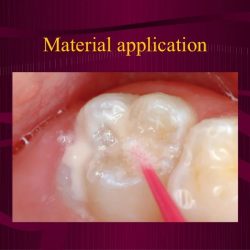 Pit and fissure stains or cavities